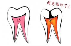 急性牙髓炎发作是什么症状