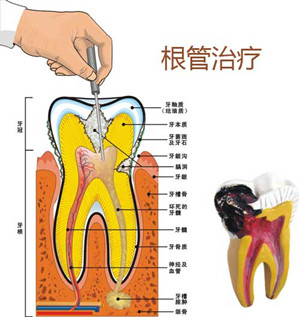 做完根管治疗后牙疼怎么办