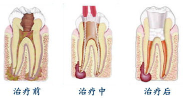 根管治疗步骤