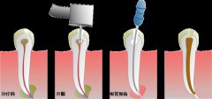 根管治疗会有并发症吗