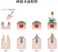 种植牙的收费怎样