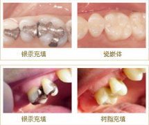 什么是补牙？补牙需要多少钱