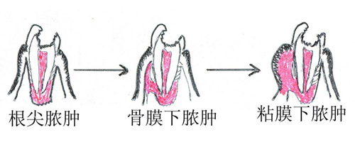 重度牙周病