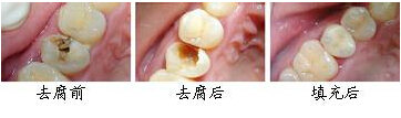 乌鲁木齐龋齿治疗要多少钱