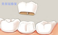 美容冠治疗的优势有哪些