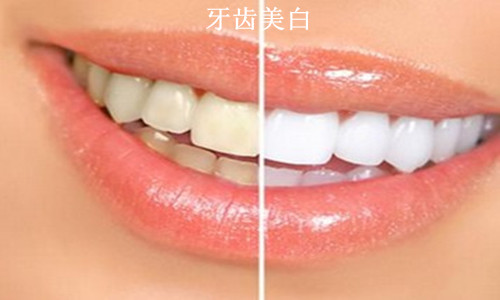 色素牙美白