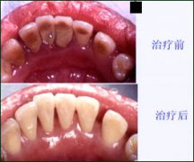 牙周炎的治疗方法有哪些