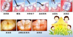 孩子做窝沟封闭的步骤