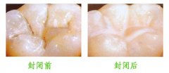 预防儿童窝沟龋的有效方法