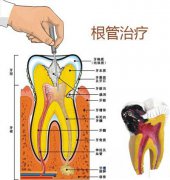 福州牙髓炎引起牙疼该如何治疗