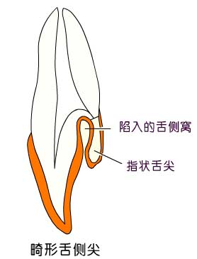 苏州牙齿内陷可以治好吗