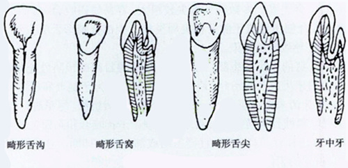 苏州牙齿内陷可以治好吗