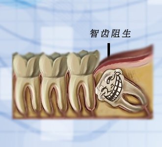 阻生齿引起智齿冠周炎