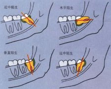 我们该怎样处理智齿阻生的情况