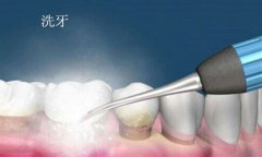 洗牙的价格因素有哪些