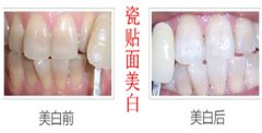 四环素牙是怎么形成的