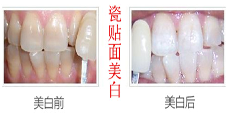 四环素牙做贴面美白