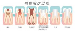 福州根管治疗能治哪些牙齿疾病呢