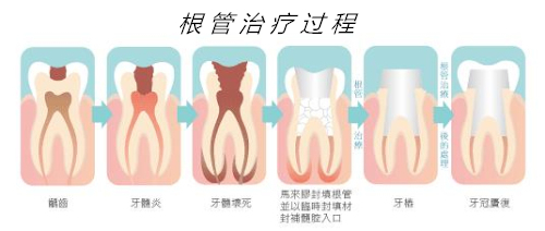根管治疗