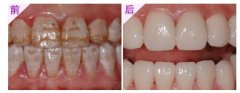 氟斑牙洗牙可以改善吗
