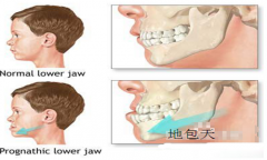 儿童矫正地包天是时机和护理