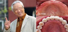 福州种植牙需要多长时间