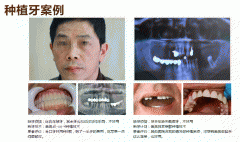 牙齿掉了多颗怎么办