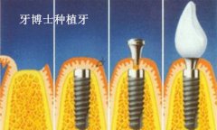种植牙会影响其他牙根吗