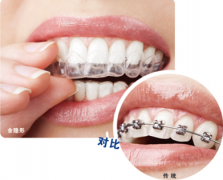 做牙齿矫正会有疼痛感吗