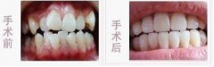 福州老鼠牙修复哪里好