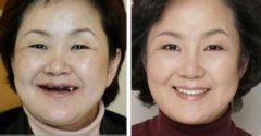 福州全口牙齿缺失怎么办
