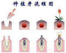 专家详解后牙种植过程