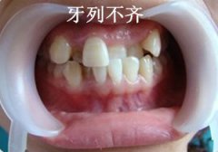 牙齿排列不齐的情况也应该矫正吗
