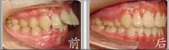 福州带牙套能矫正龅牙吗