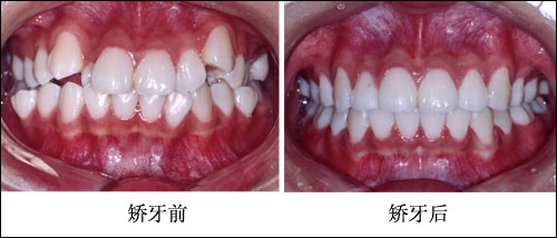牙列拥挤矫正前后牙齿的状态对比图