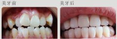 虎牙的矫正方法有哪些?