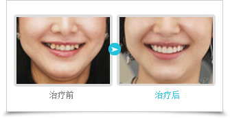 虎牙是什么？形成虎牙的原因是什么？