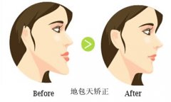 地包天矫正过程图解