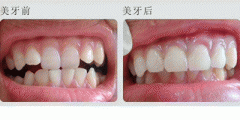 福州美容冠多少钱