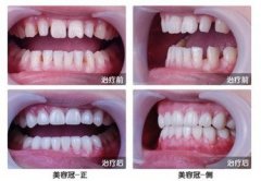 美容冠能用多长时间