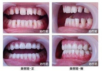 美容冠