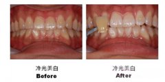 遗传性色素牙怎么办