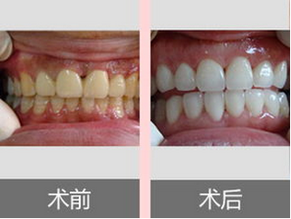 天津如何美白色素牙