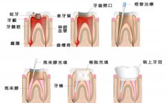 根管治疗有哪些优点