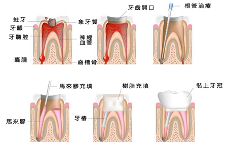 根管治疗