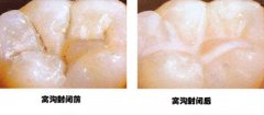 小孩有龋齿怎么办？
