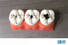 龋齿产生的原因是什么？