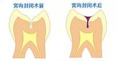 儿童窝沟封闭做完就可以了吗