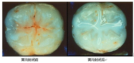 窝沟封闭修复前后对比图