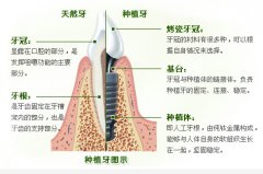 种植牙修复后还要注意什么事项